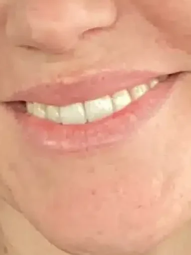 Lip Flip after — Esthetic Finesse