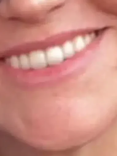 Lip Flip before — Esthetic Finesse