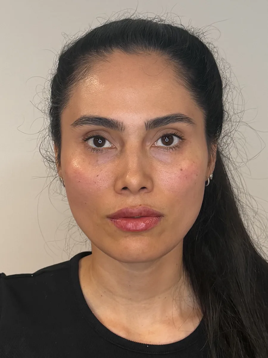 Lips, Under-Eye & Midface after — Esthetic Finesse