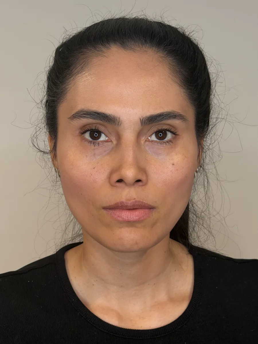 Lips, Under-Eye & Midface before — Esthetic Finesse