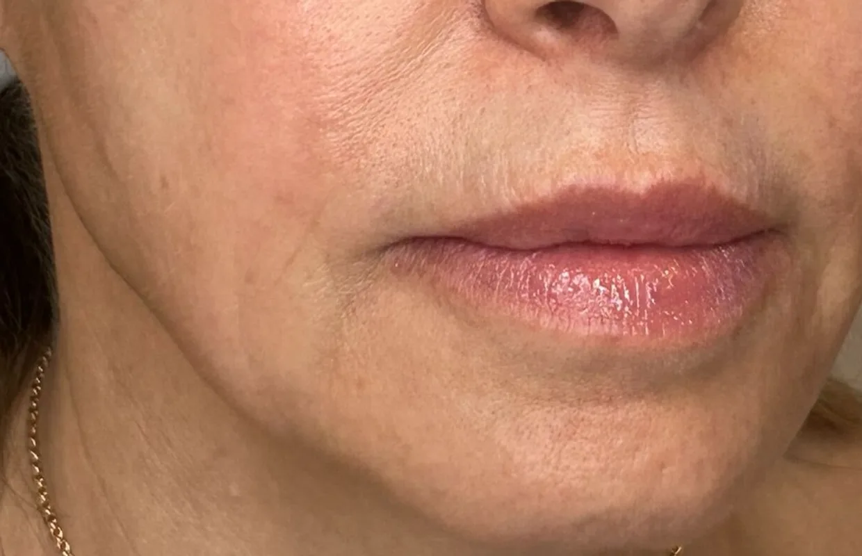 Lower-Face Rejuvenation before — Esthetic Finesse