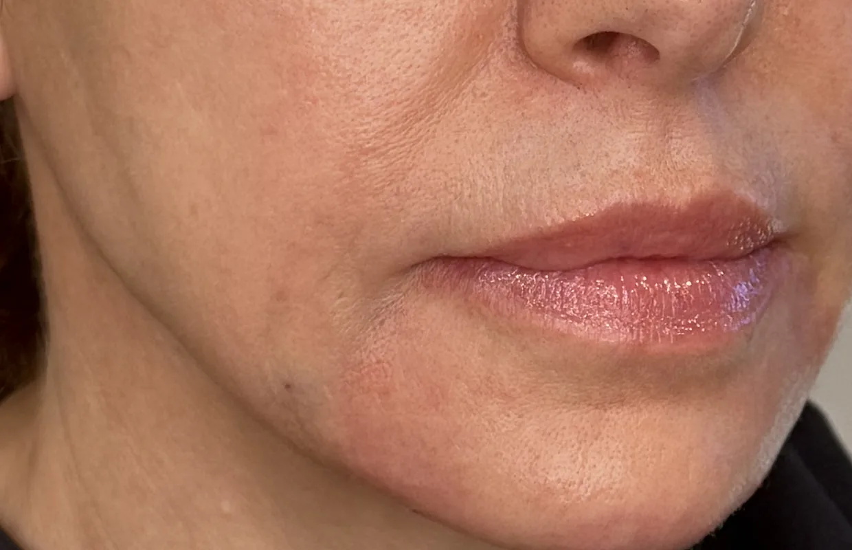 Lower-Face Rejuvenation after — Esthetic Finesse