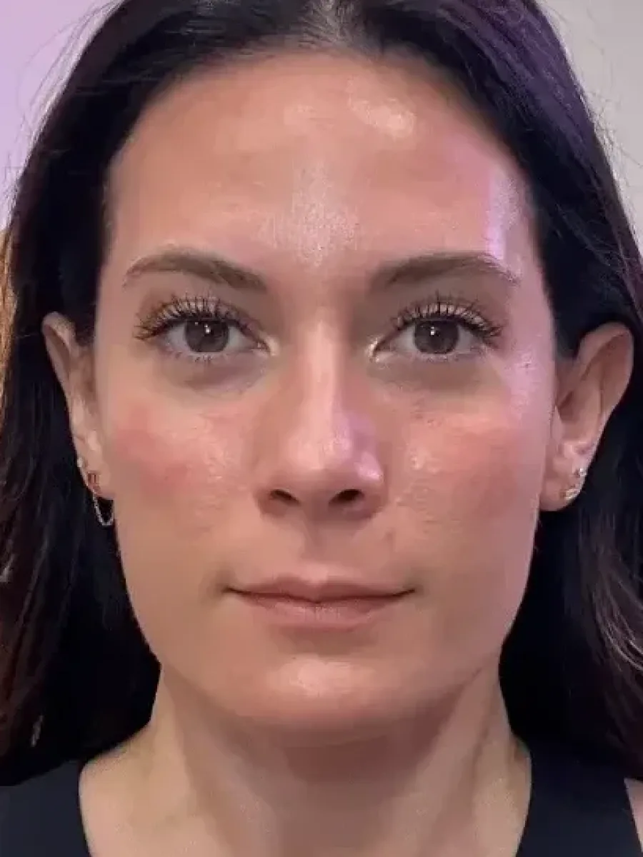 Masseter, Temporal and Midface after — Esthetic Finesse
