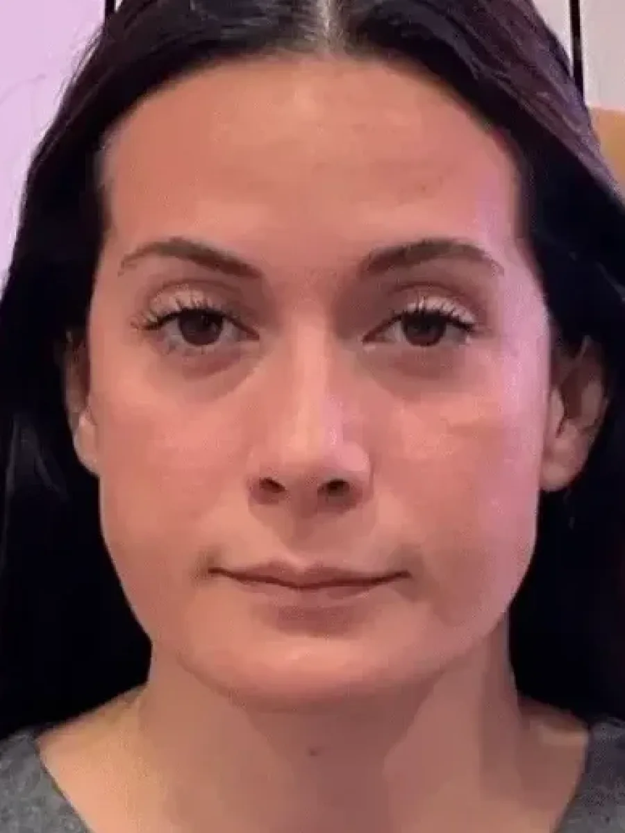 Masseter, Temporal and Midface before — Esthetic Finesse