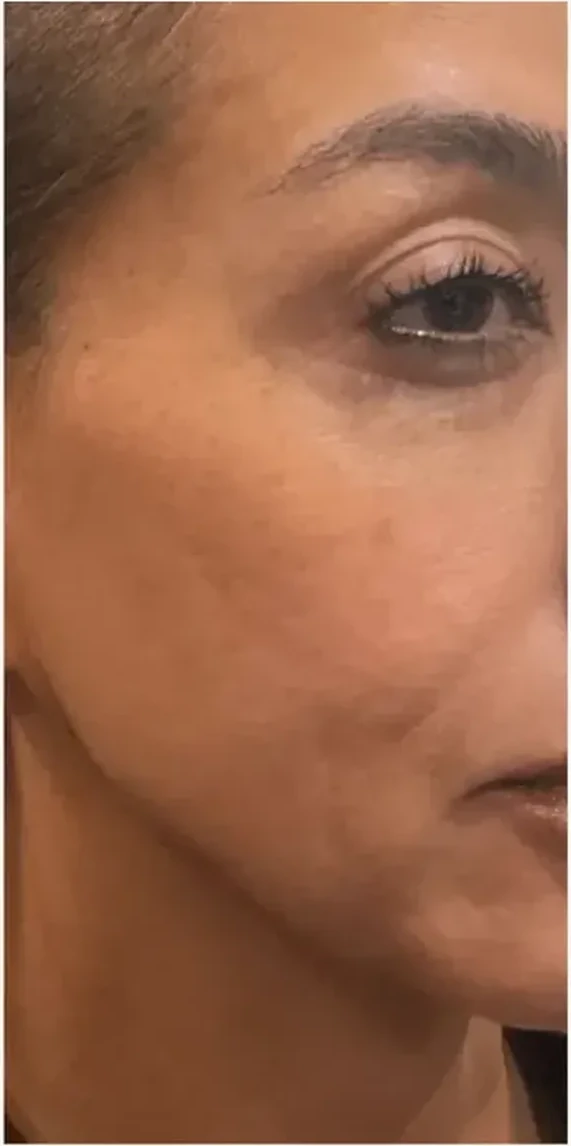 Skin Texture after — Esthetic Finesse