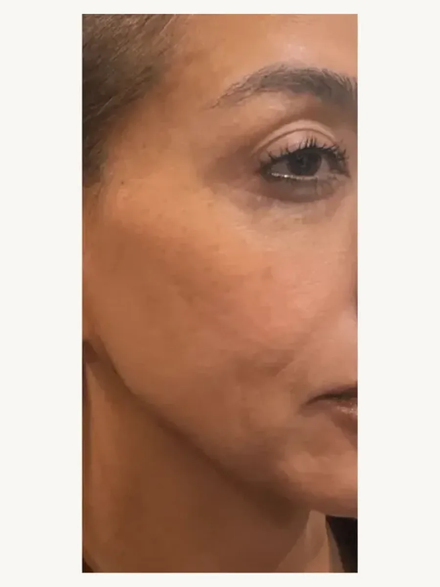 Skin Texture after — Esthetic Finesse