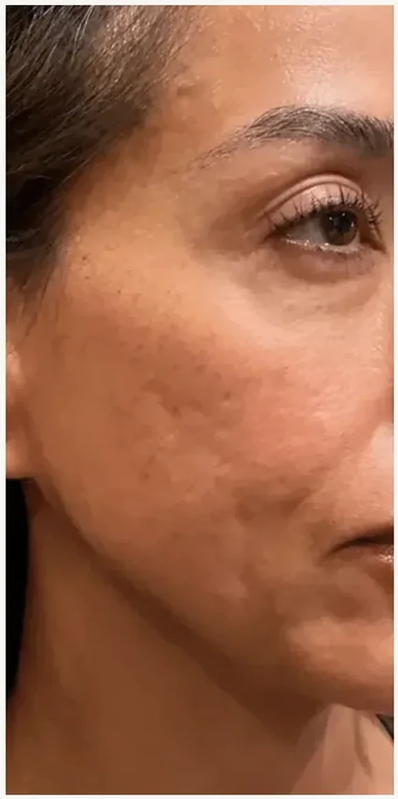 Skin Texture before — Esthetic Finesse