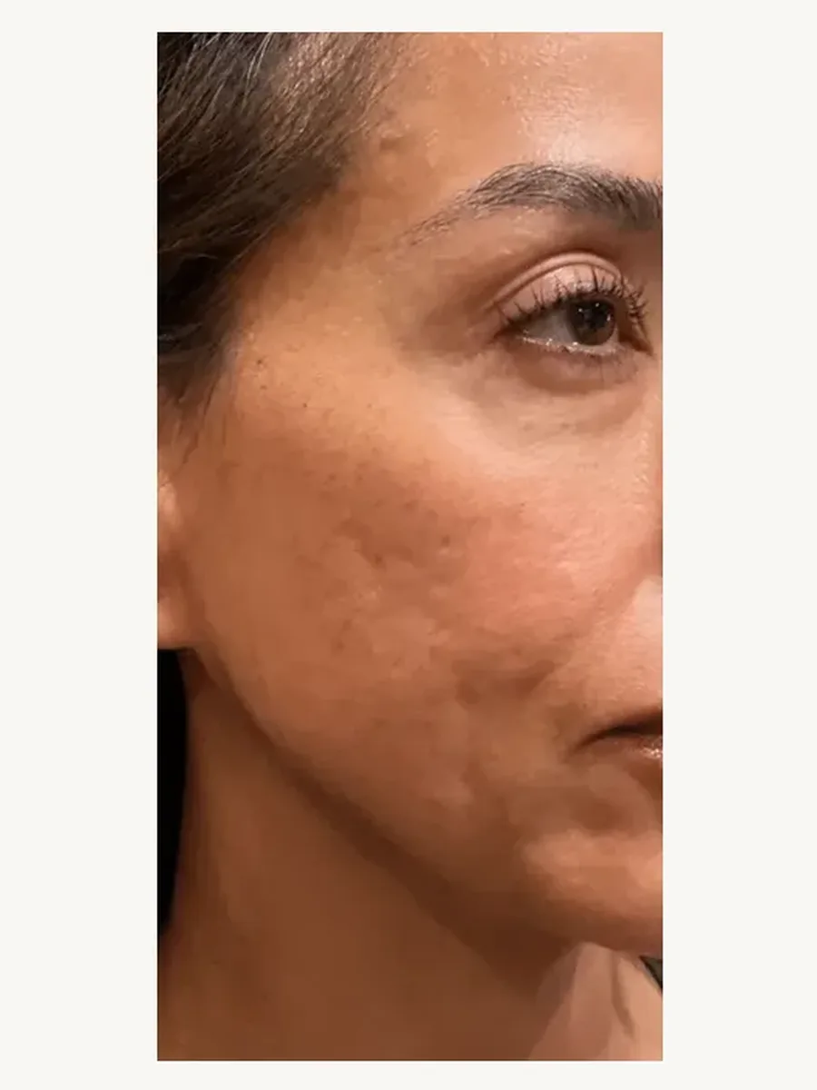 Skin Texture before — Esthetic Finesse