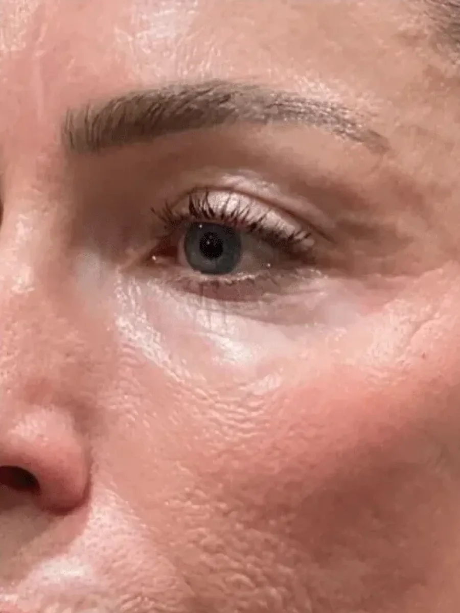 Tone and Clarity before — Esthetic Finesse
