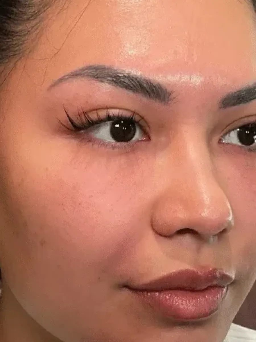 PRF Renewal after — Esthetic Finesse