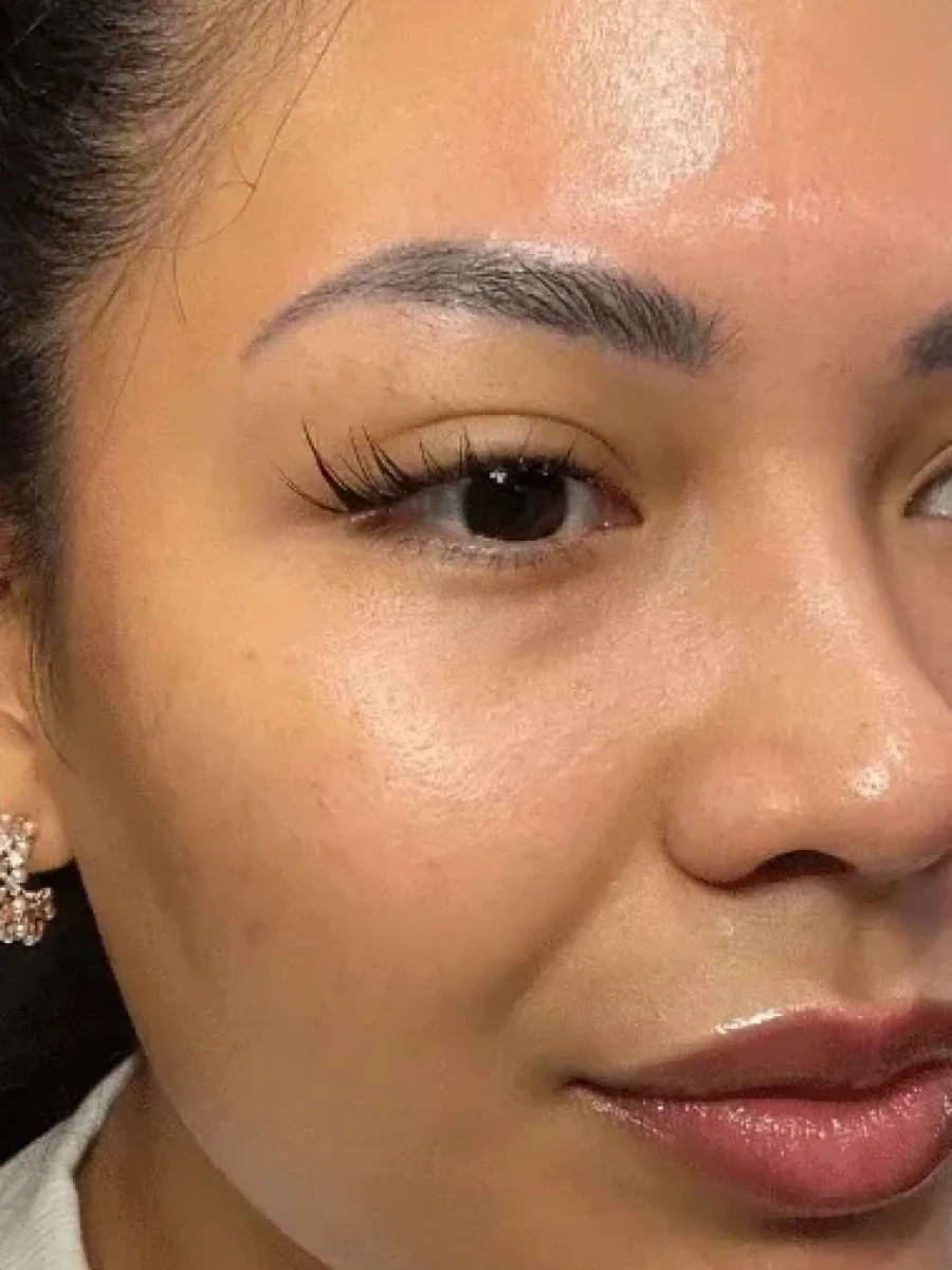 PRF Renewal before — Esthetic Finesse