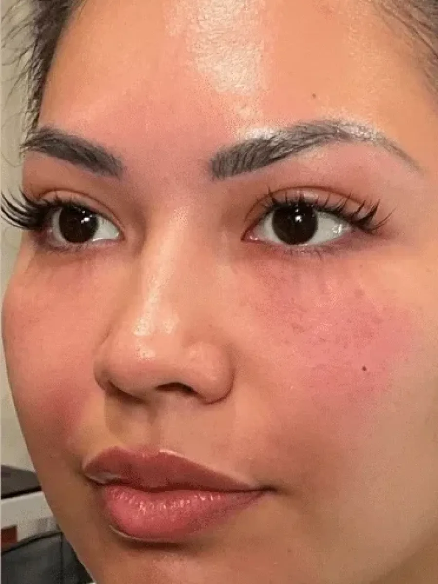 Under-Eye and Folds after — Esthetic Finesse