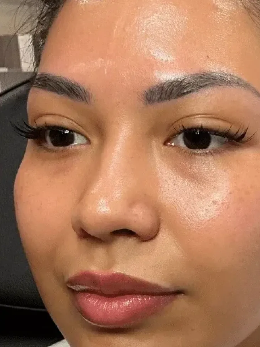 Under-Eye and Folds before — Esthetic Finesse
