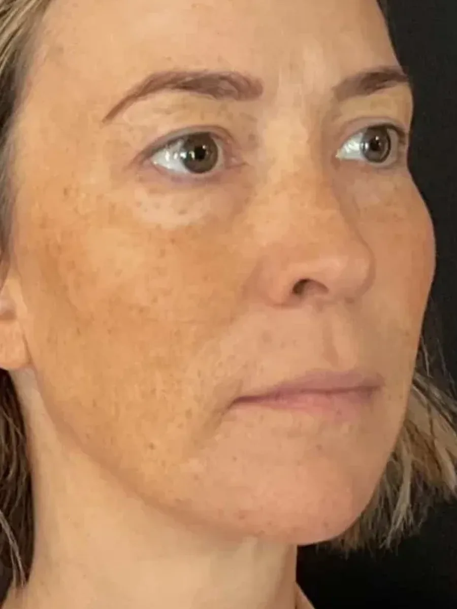 Natural Refinement after — Esthetic Finesse