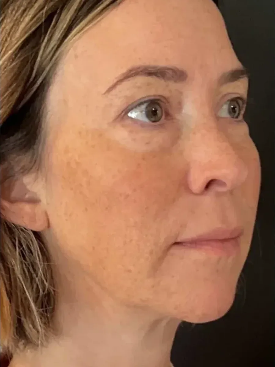 Natural Refinement before — Esthetic Finesse