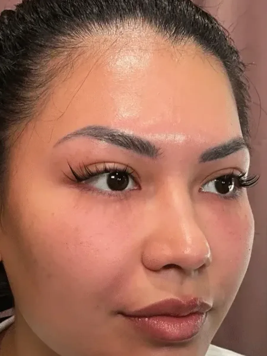 Under-Eye and Folds after — Esthetic Finesse