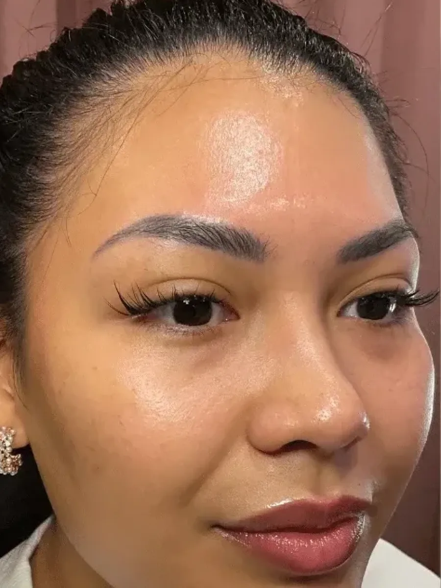 Under-Eye and Folds before — Esthetic Finesse