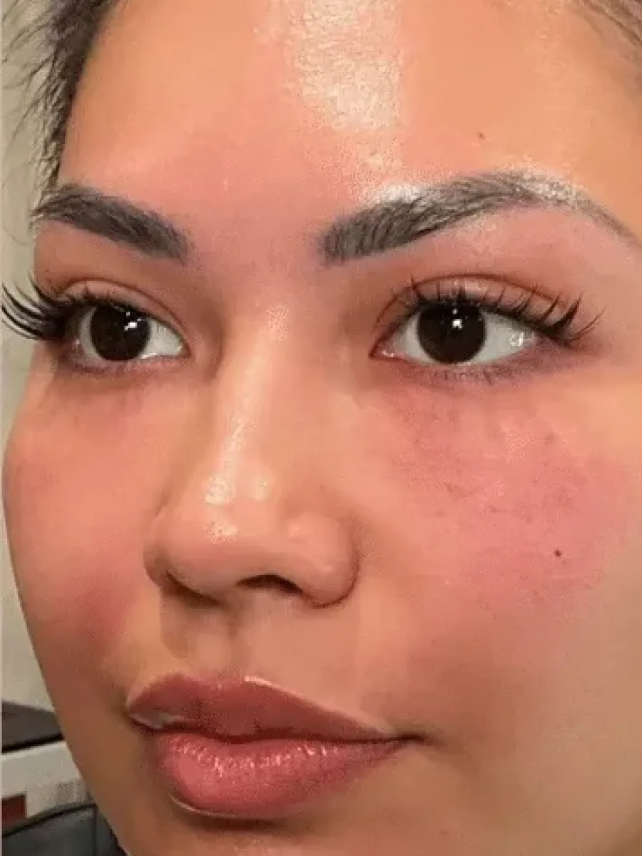 Full-Face Renewal after — Esthetic Finesse