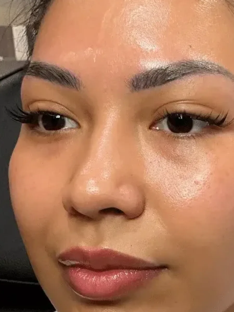 Full-Face Renewal before — Esthetic Finesse