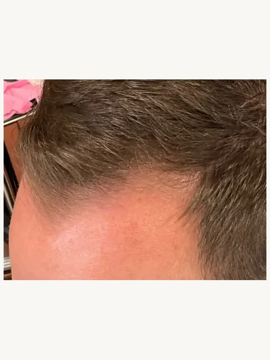 PRF Hair Restoration after — Esthetic Finesse