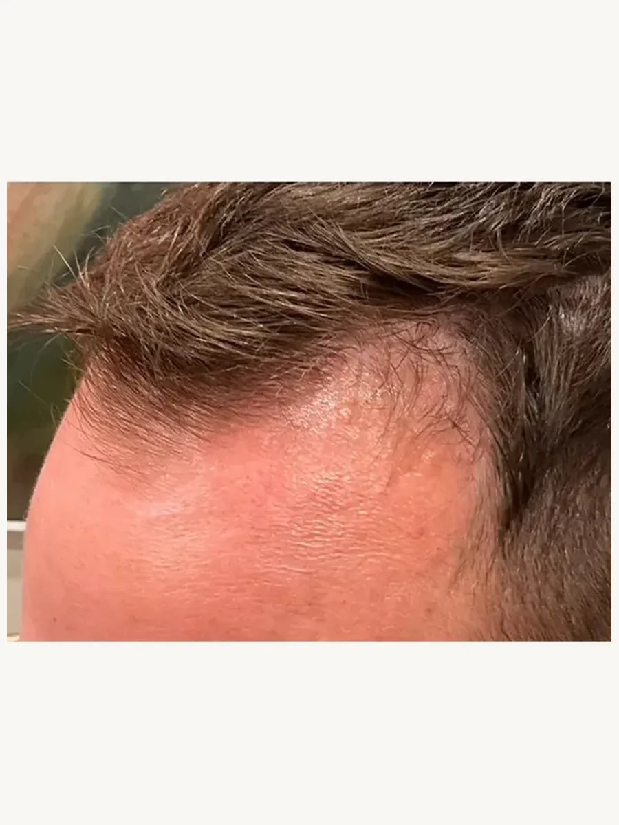 PRF Hair Restoration before — Esthetic Finesse