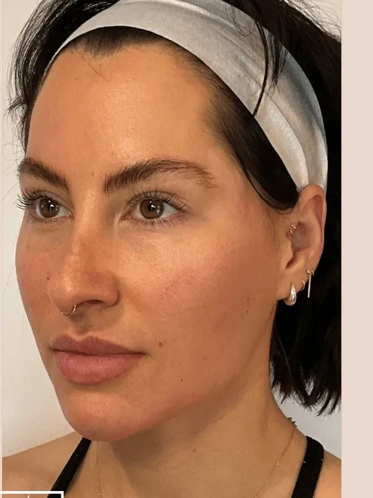 Cheek Structure after — Esthetic Finesse