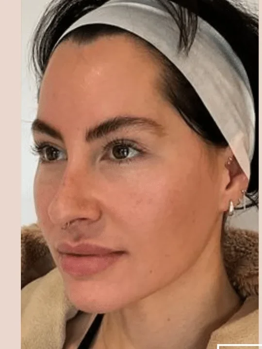 Cheek Structure before — Esthetic Finesse