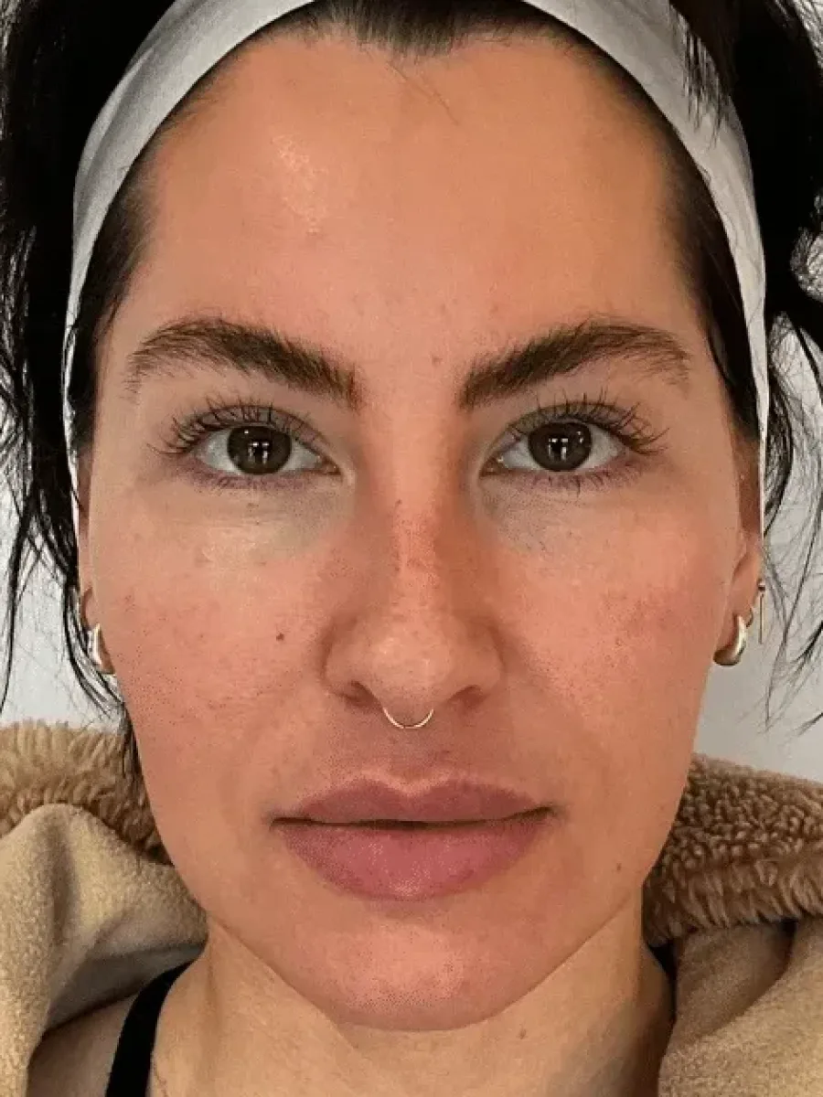 Cheek Contour before — Esthetic Finesse