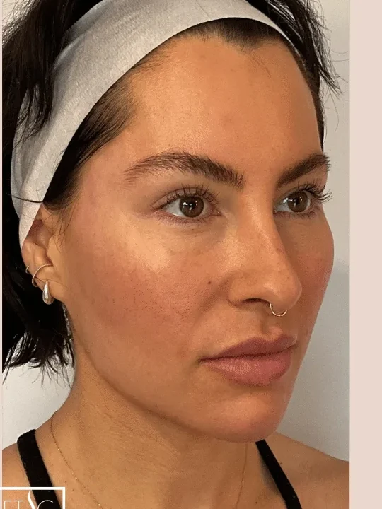 Midface Lift after — Esthetic Finesse