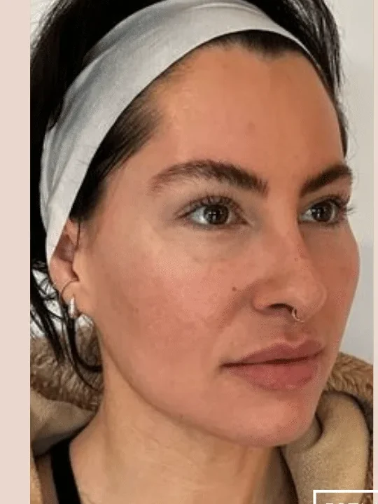 Midface Lift before — Esthetic Finesse