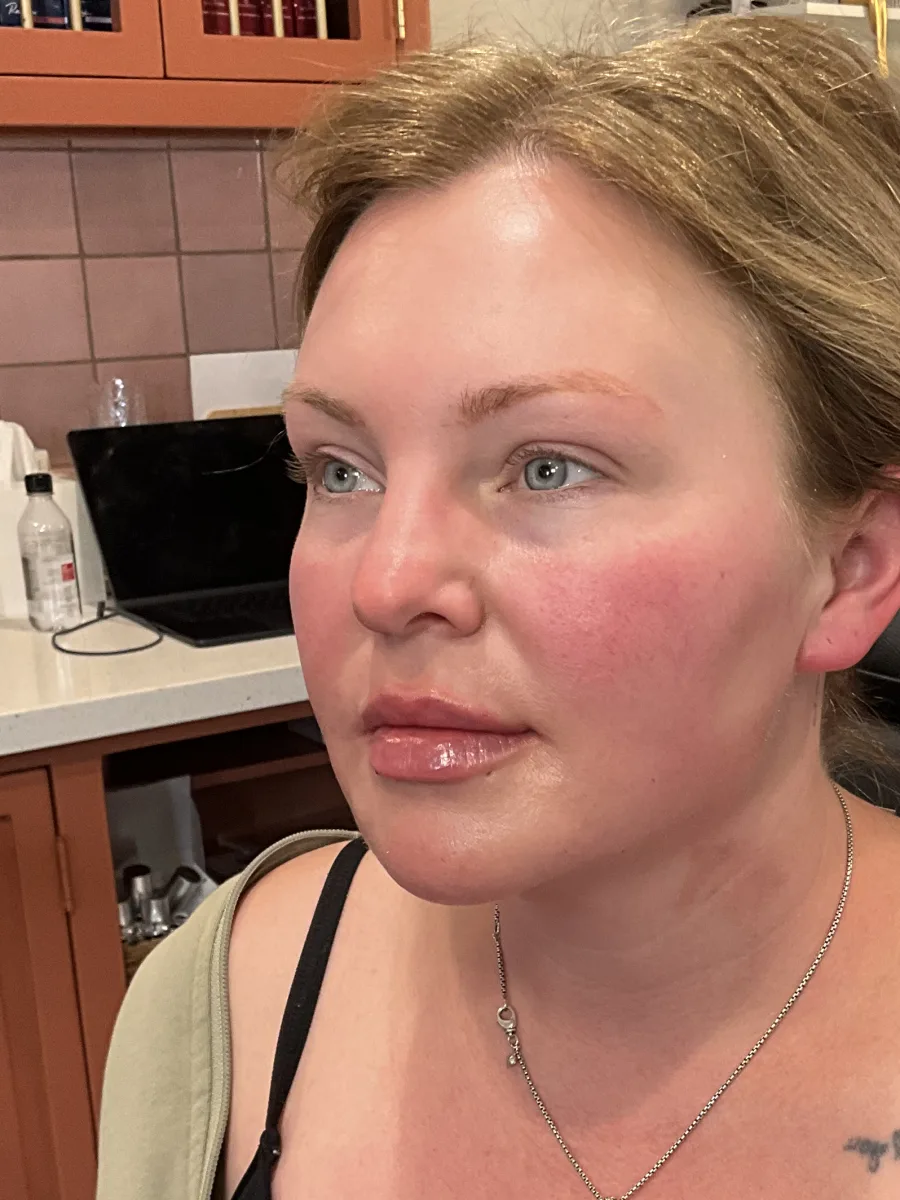 Full-Face Balancing & Jawline Creation with Radiesse after — Esthetic Finesse