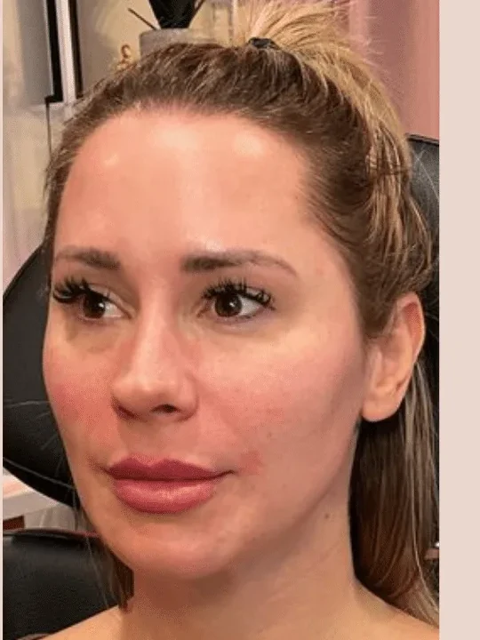 Sculptra Collagen Restoration after — Esthetic Finesse