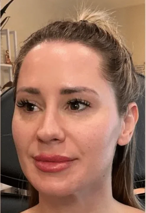 Collagen Restoration before — Esthetic Finesse
