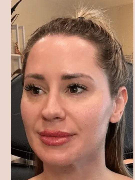 Sculptra Collagen Restoration before — Esthetic Finesse