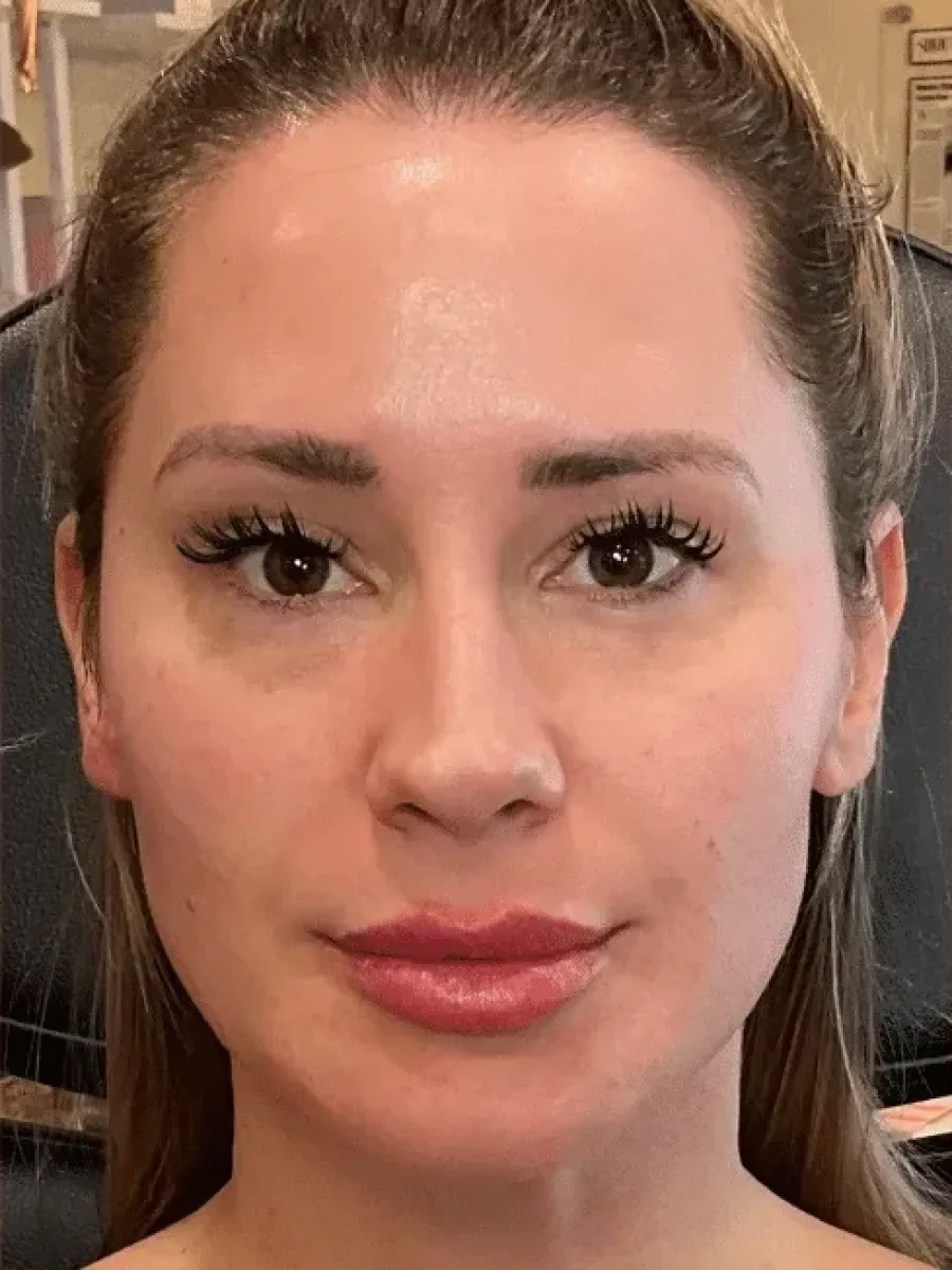 Natural Volume before — Esthetic Finesse