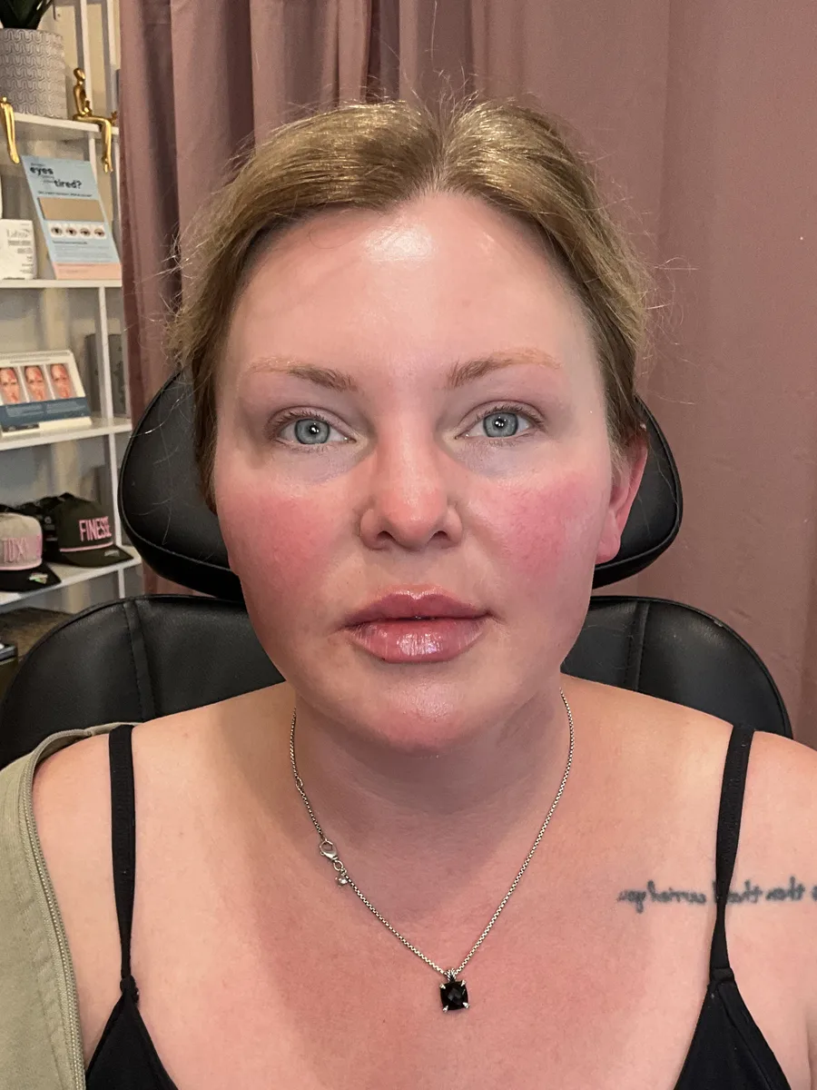 Gradual Renewal after — Esthetic Finesse