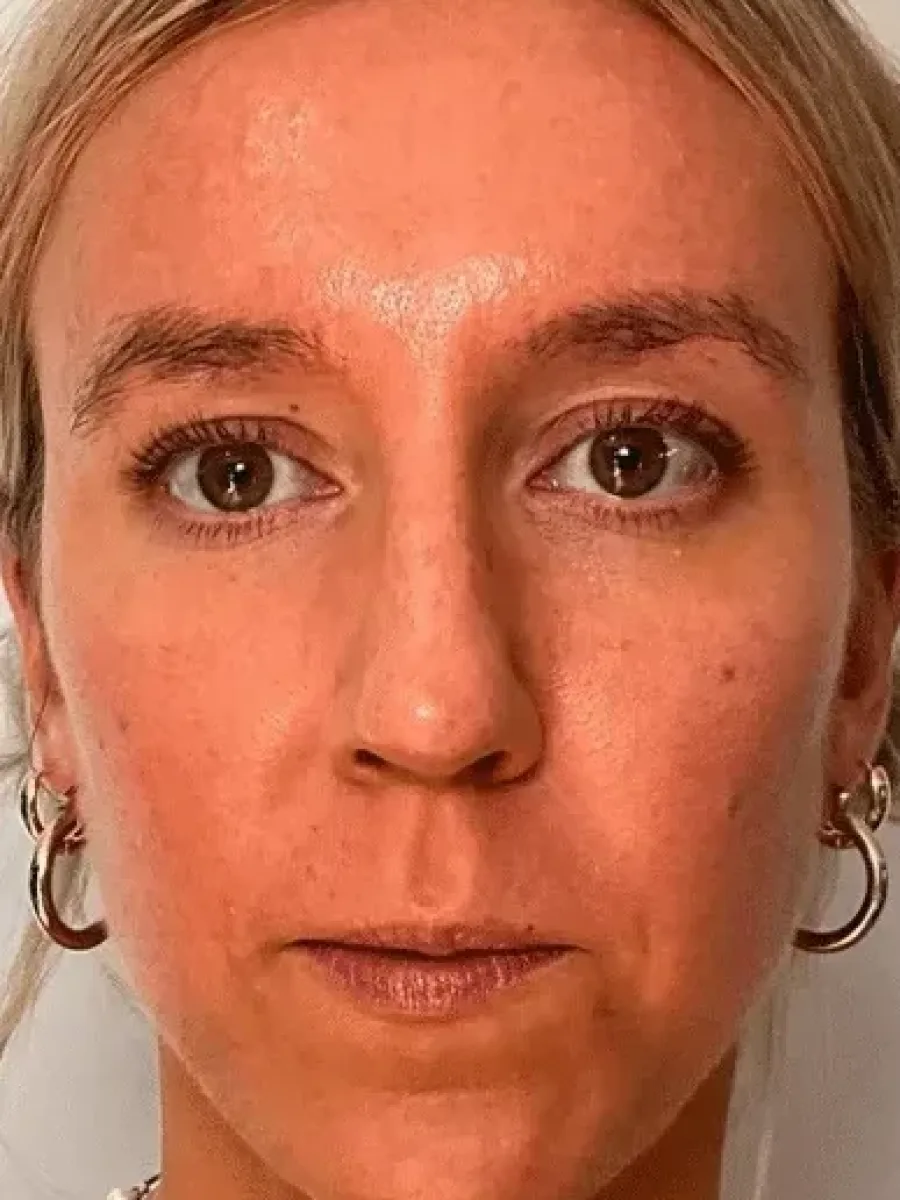 Lifted Contours after — Esthetic Finesse