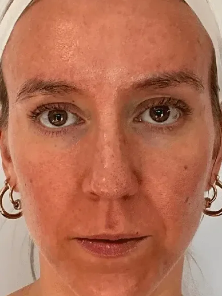 Lifted Contours before — Esthetic Finesse