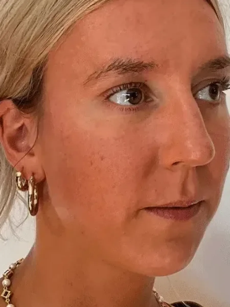 Restored Fullness after — Esthetic Finesse