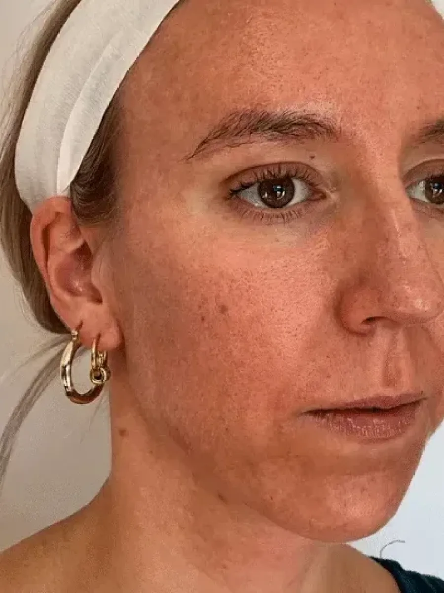 Restored Fullness before — Esthetic Finesse