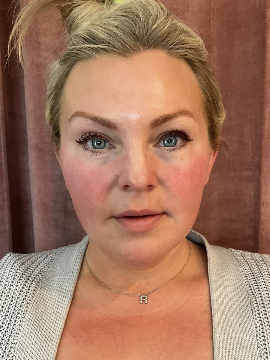 Full-Face Balancing with Sculptra before — Esthetic Finesse