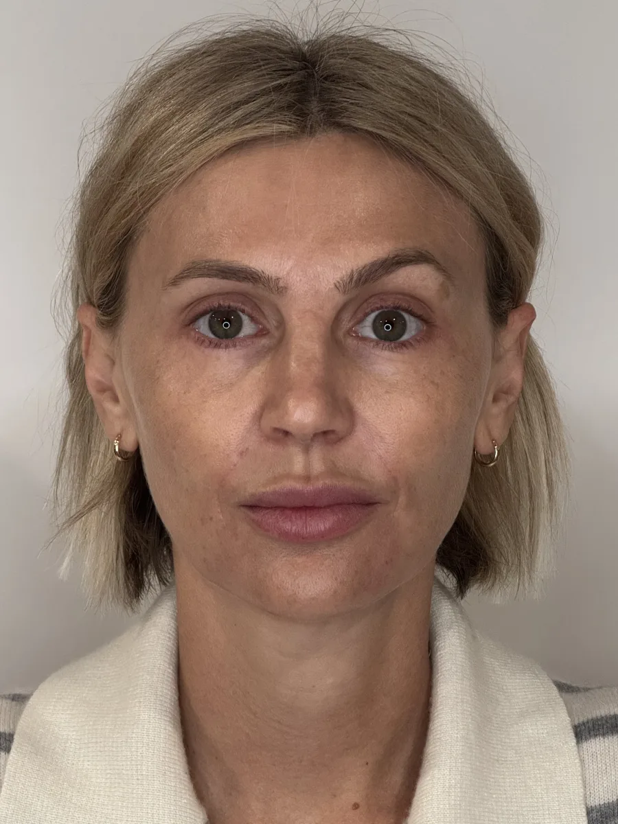 Collagen Restoration after — Esthetic Finesse