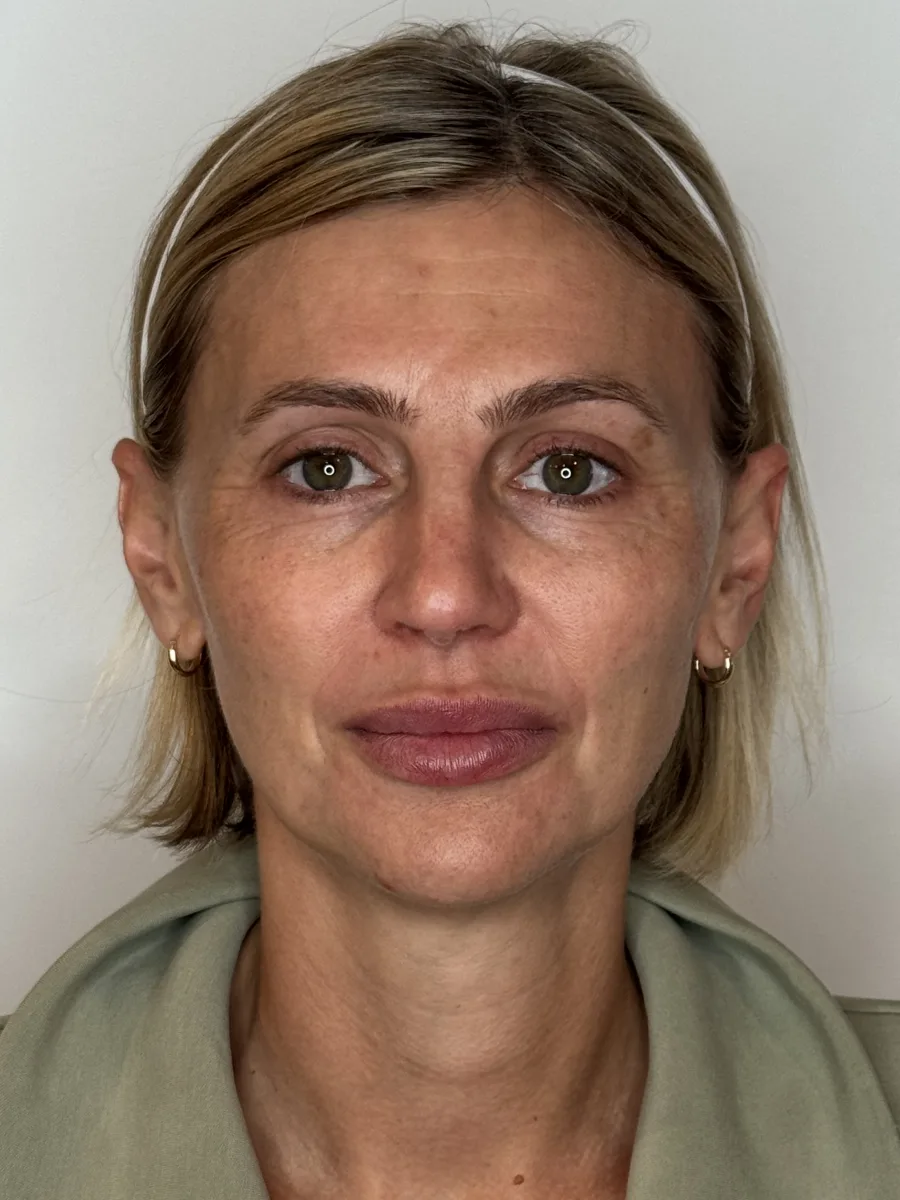 Collagen Restoration before — Esthetic Finesse