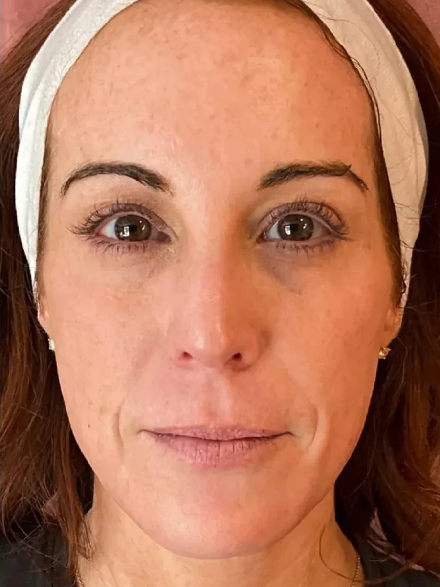 Skin Quality & Glow after — Esthetic Finesse