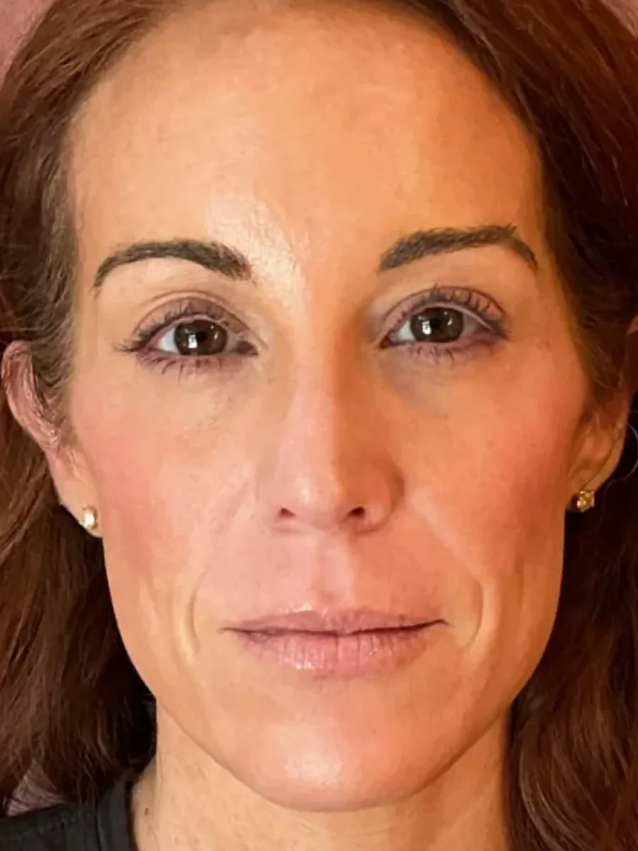 Skin Quality & Glow before — Esthetic Finesse