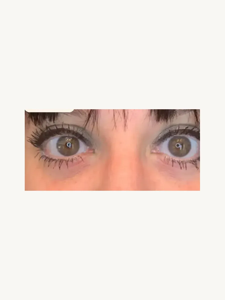 Brighter Eyes after — Esthetic Finesse