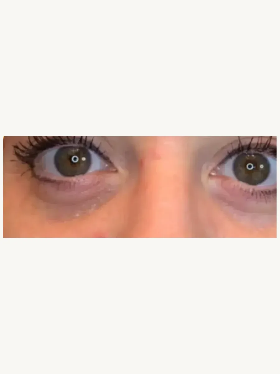 Brighter Eyes before — Esthetic Finesse