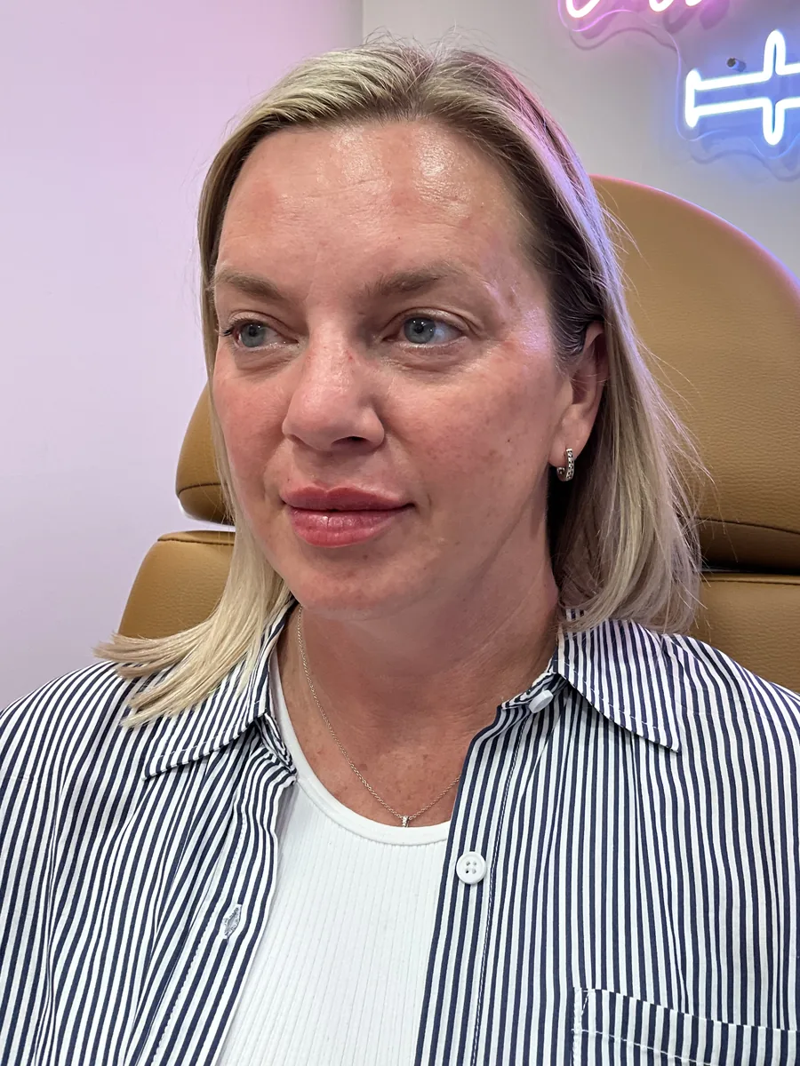 Lip Filler after